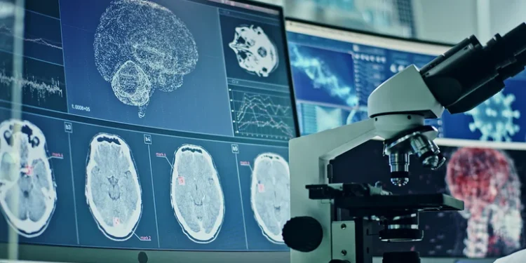 Después del COVID grave, el cerebro puede sufrir cambios similares a la enfermedad de Alzheimer